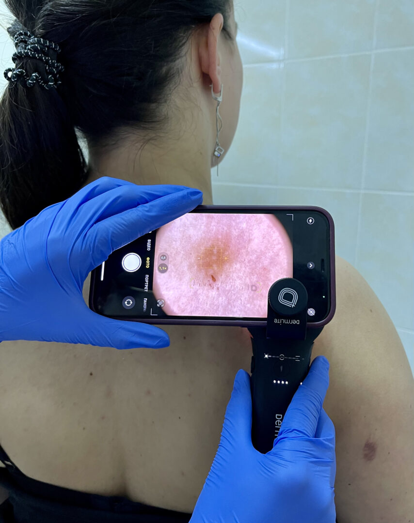 Родимка чи меланома?