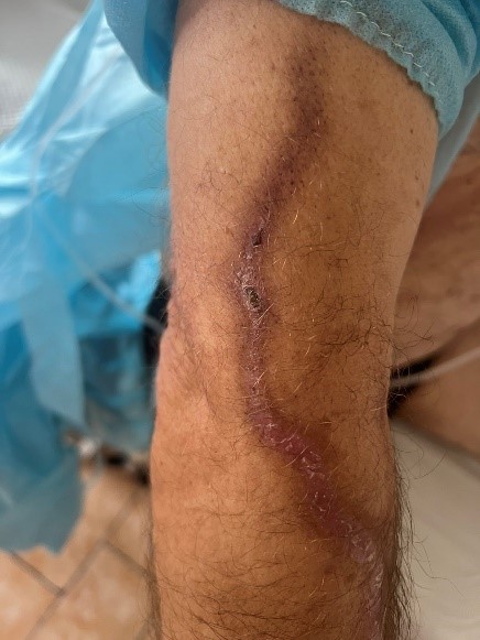 Порт-система для введення препаратів  - «золотий стандарт»