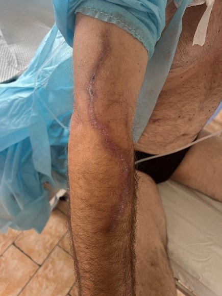 Порт-система для введення препаратів  - «золотий стандарт»