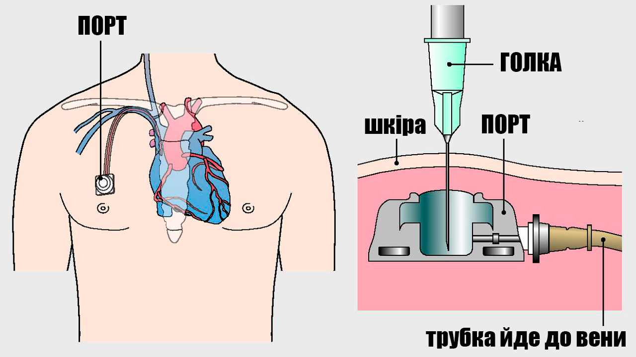 Порт-система для введення препаратів  - «золотий стандарт»