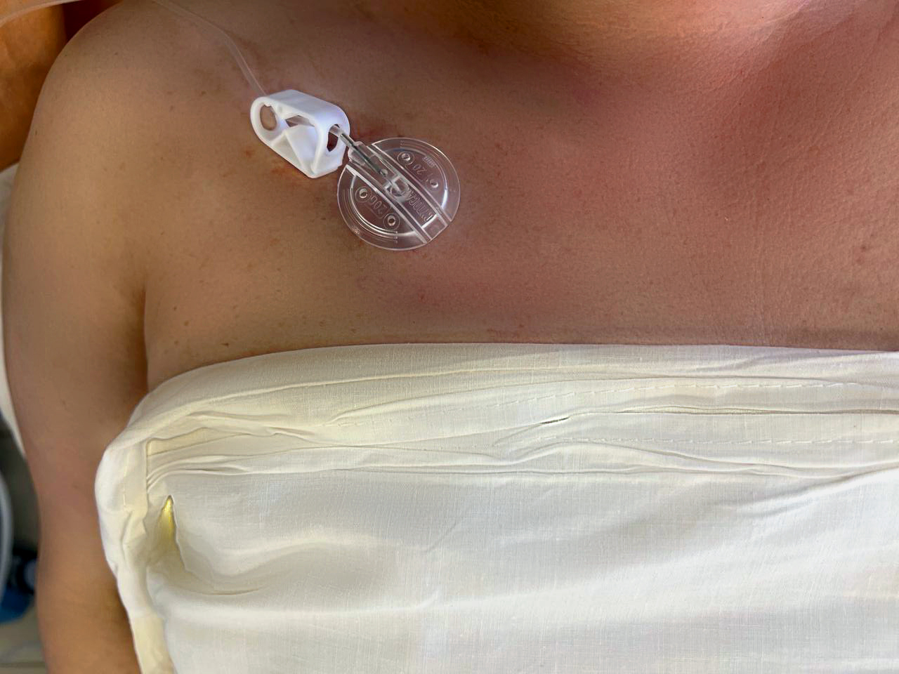 Порт-система для введення препаратів  - «золотий стандарт»